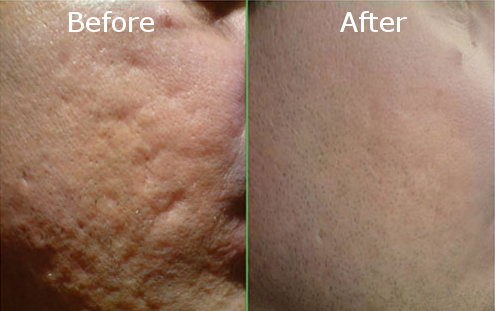 acne scars treatment methods